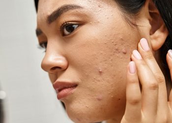 বয়ঃসন্ধিতে মুখে ব্রণ: কারণ মানসিক চাপের প্রভাব ও প্রতিকার