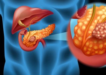 অগ্ন্যাশয়ের ক্যান্সারের ঝুঁকি বাড়ছে: কোন লক্ষণ দেখা দিলে সতর্ক হবেন
