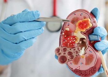 যেসব অভ্যাসের ভুলে কিডনিতে বাসা বাঁধছে পাথর